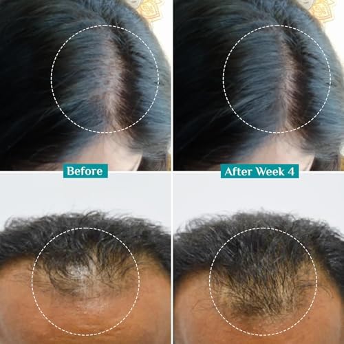 Pilgrim Redensyl 3% + Anagain 4% + Baicapil Advanced Hair Growth Serum (50ml) for Scalp with Korean Black Rice, Saw Palmetto | Control Hair Fall, Stimulate Hair Regrowth, Hair (50ml)